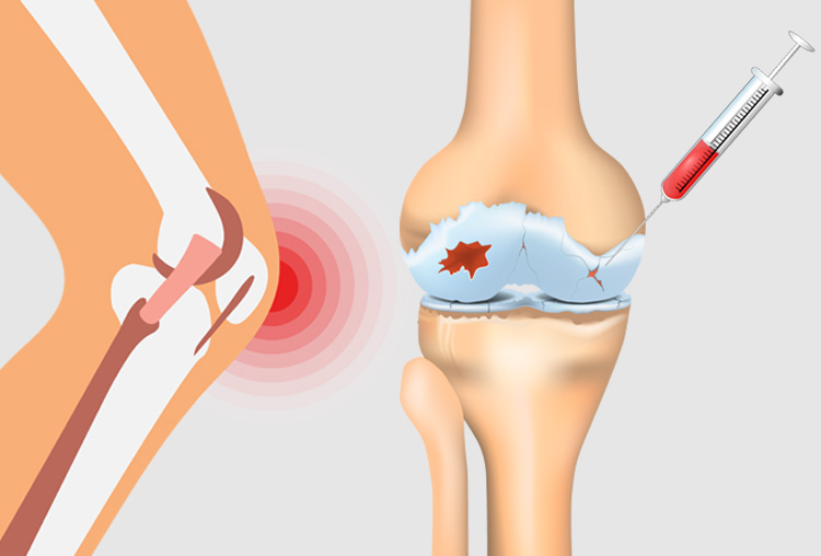 Ilustração mostra a aplicação dos medicamentos no joelho - infiltração no joelho